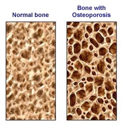 bone-loss bone-loss